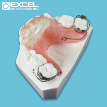 Anterior Bite Plate - Excel Orthodontics