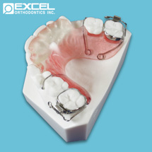 Anterior Bite Plate - Excel Orthodontics