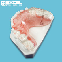 Posterior Bite Plate - Excel Orthodontics