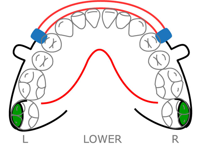 Retention Excel Orthodontics