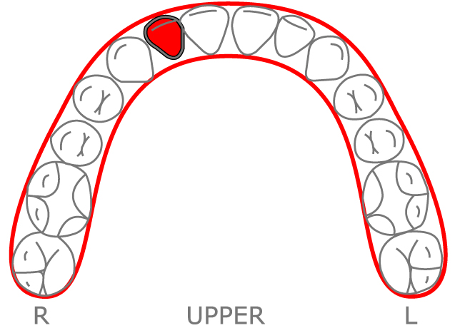 Retention Excel Orthodontics